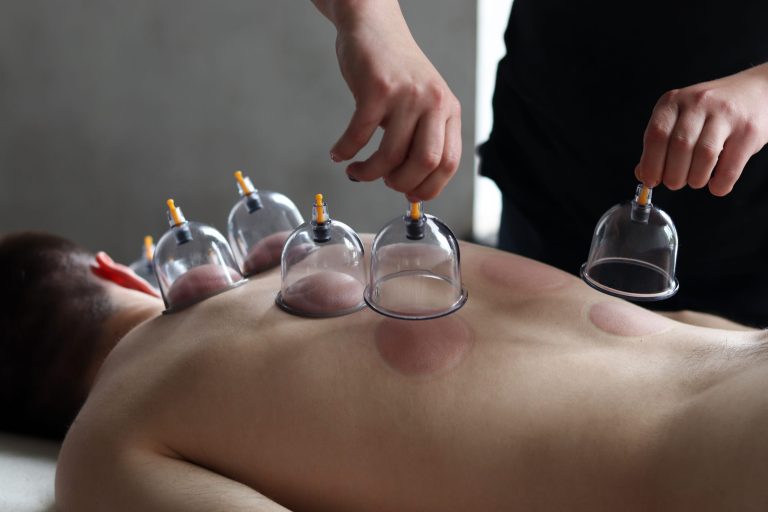 formation dry hijama cupping